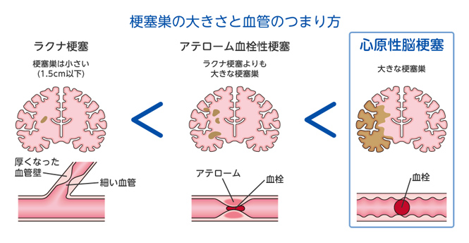 梗塞巣の大きさと血管のつまり方 ラクナ梗塞：梗塞巣は小さい（1.5cm以下） アテローム血栓性梗塞：ラクナ梗塞よりも大きな梗塞巣 心原性脳梗塞：大きな梗塞巣