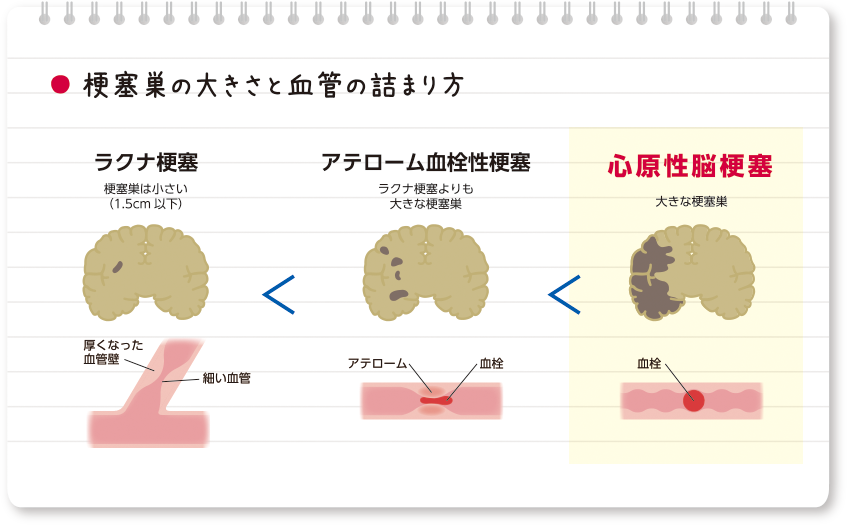 梗塞巣の大きさと血管の詰まり方